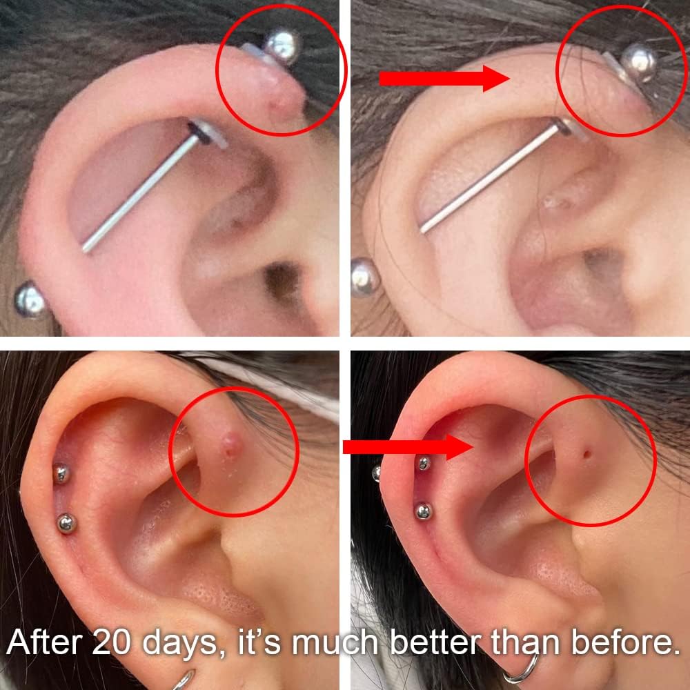 Healing a Piercing Bump