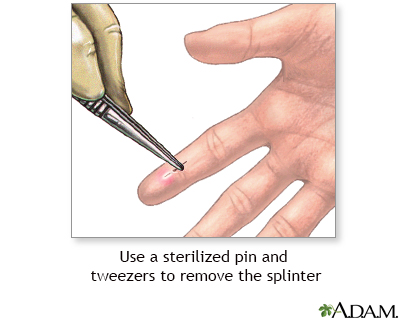 How to remove a splinter you can’t see